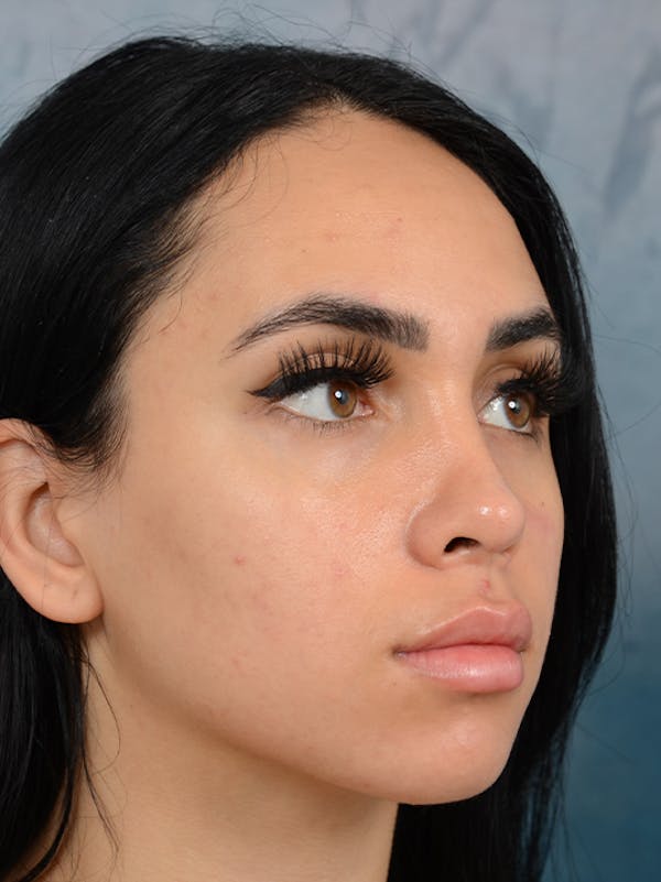 Rhinoplasty Before & After Gallery - Patient 16862101 - Image 8