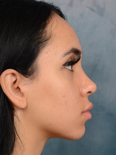 Rhinoplasty Before & After Gallery - Patient 16862101 - Image 10