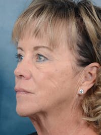 Deep Plane Facelift Before & After Gallery - Patient 25623505 - Image 1