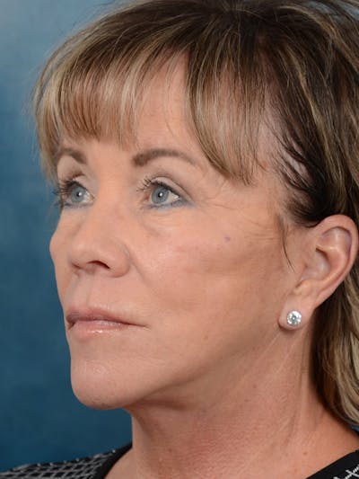 Deep Plane Facelift Before & After Gallery - Patient 25623505 - Image 2