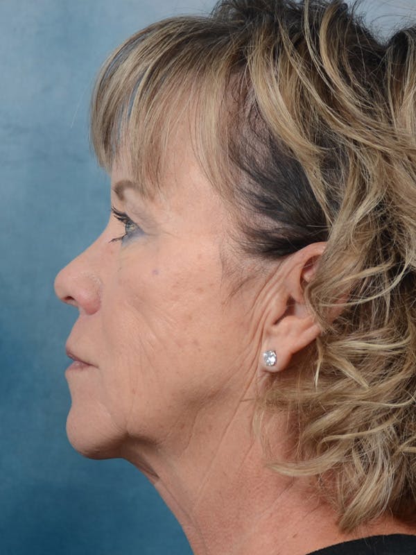 Deep Plane Facelift Before & After Gallery - Patient 25623505 - Image 5