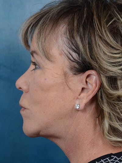 Deep Plane Facelift Before & After Gallery - Patient 25623505 - Image 6