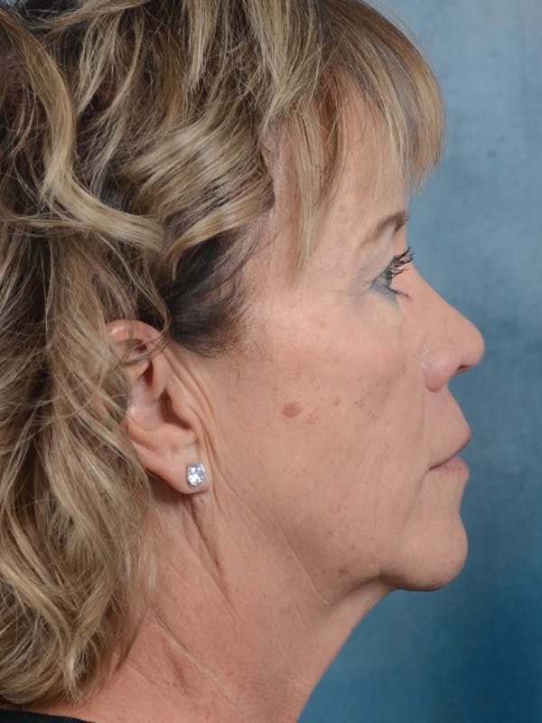 Deep Plane Facelift Before & After Gallery - Patient 25623505 - Image 9