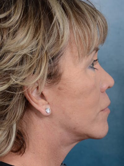Deep Plane Facelift Before & After Gallery - Patient 25623505 - Image 10