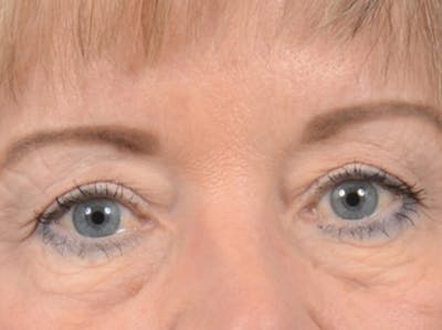 Eyelid Lift Before & After Gallery - Patient 25623537 - Image 1