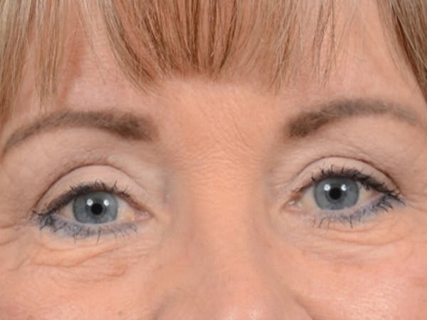 Eyelid Lift Before & After Gallery - Patient 25623537 - Image 2