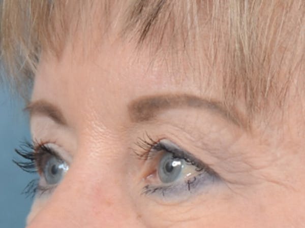 Eyelid Lift Before & After Gallery - Patient 25623537 - Image 3