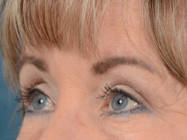 Eyelid Lift Before & After Gallery - Patient 25623537 - Image 4