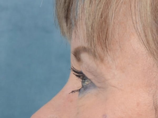 Eyelid Lift Before & After Gallery - Patient 25623537 - Image 5