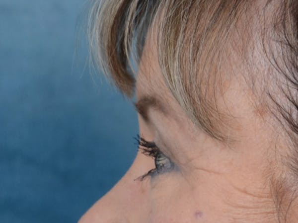 Eyelid Lift Before & After Gallery - Patient 25623537 - Image 6
