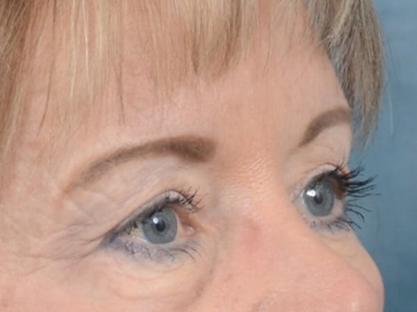 Eyelid Lift Before & After Gallery - Patient 25623537 - Image 7