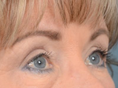 Eyelid Lift Before & After Gallery - Patient 25623537 - Image 8