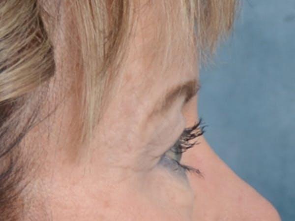 Eyelid Lift Before & After Gallery - Patient 25623537 - Image 9