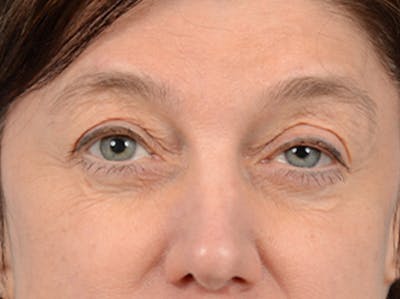 Eyelid Lift Before & After Gallery - Patient 14605191 - Image 1