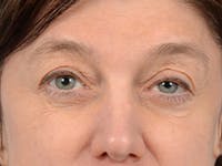 Eyelid Lift Before & After Gallery - Patient 14605191 - Image 1