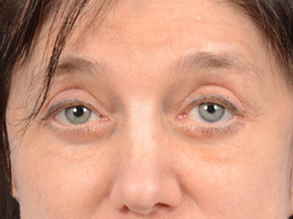 Eyelid Lift Before & After Gallery - Patient 14605191 - Image 2