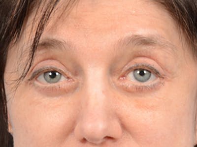 Eyelid Lift Before & After Gallery - Patient 14605191 - Image 2