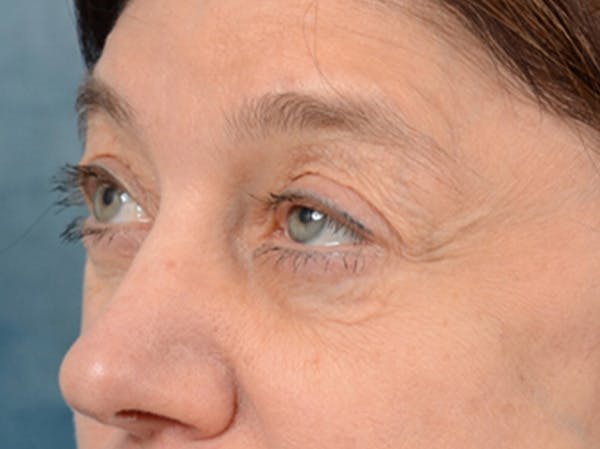 Eyelid Lift Before & After Gallery - Patient 14605191 - Image 3