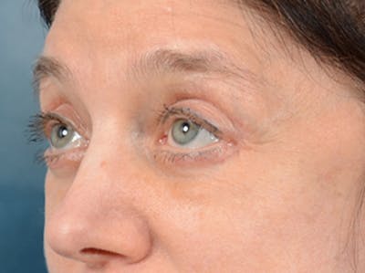 Eyelid Lift Before & After Gallery - Patient 14605191 - Image 4