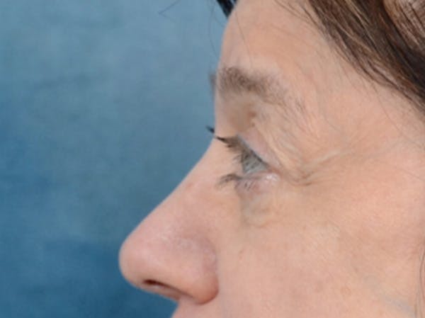 Eyelid Lift Before & After Gallery - Patient 14605191 - Image 5