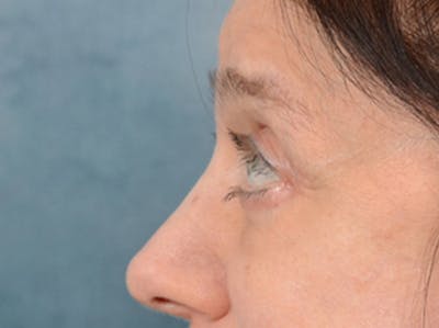 Eyelid Lift Before & After Gallery - Patient 14605191 - Image 6