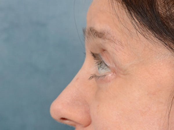 Eyelid Lift Gallery - Patient 14605191 - Image 6