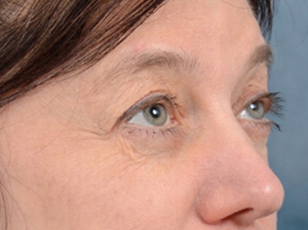 Eyelid Lift Before & After Gallery - Patient 14605191 - Image 7