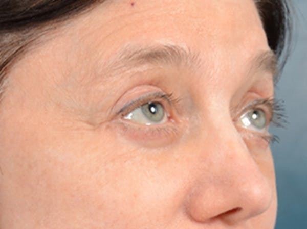 Eyelid Lift Before & After Gallery - Patient 14605191 - Image 8