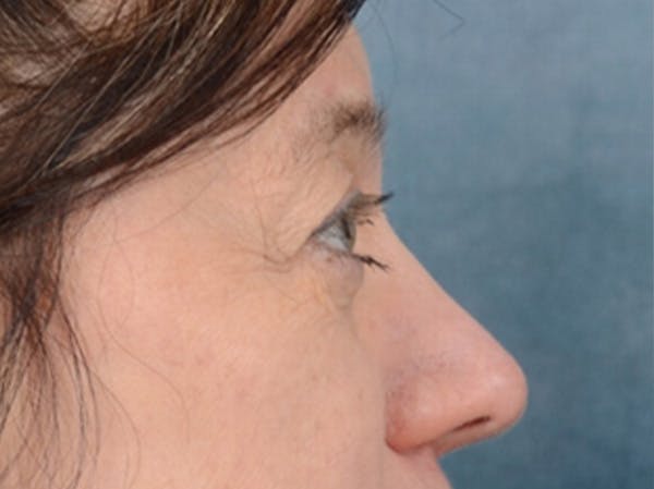 Eyelid Lift Before & After Gallery - Patient 14605191 - Image 9
