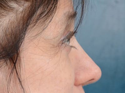 Eyelid Lift Gallery - Patient 14605191 - Image 10