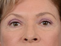 Eyelid Lift Before & After Gallery - Patient 15930444 - Image 1