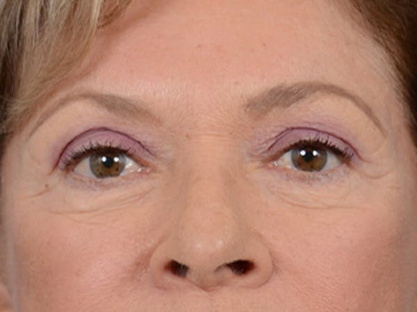 Eyelid Lift Before & After Gallery - Patient 15930444 - Image 1