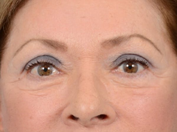 Eyelid Lift Before & After Gallery - Patient 15930444 - Image 2