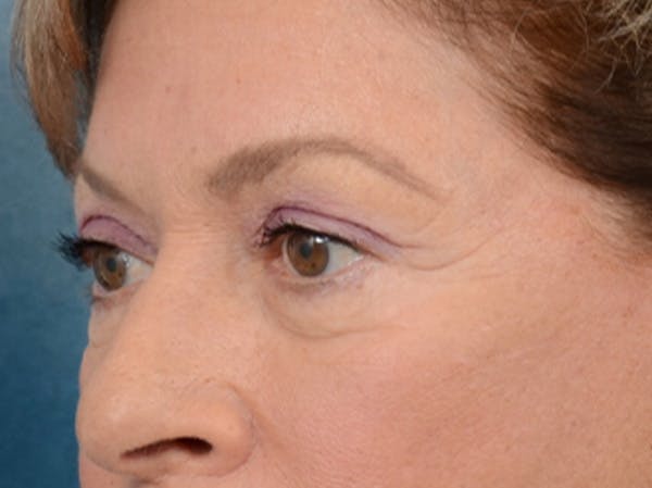 Eyelid Lift Before & After Gallery - Patient 15930444 - Image 3