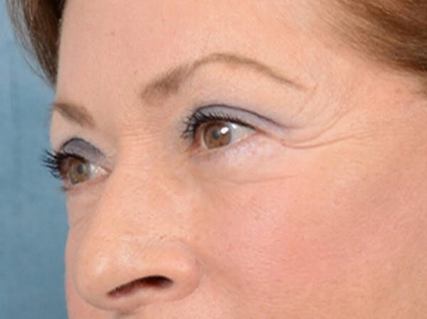 Eyelid Lift Before & After Gallery - Patient 15930444 - Image 4
