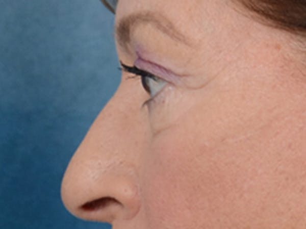 Eyelid Lift Before & After Gallery - Patient 15930444 - Image 5
