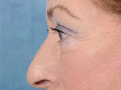 Eyelid Lift Before & After Gallery - Patient 15930444 - Image 6
