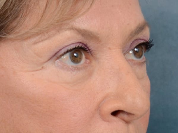 Eyelid Lift Before & After Gallery - Patient 15930444 - Image 7