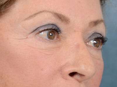 Eyelid Lift Before & After Gallery - Patient 15930444 - Image 8