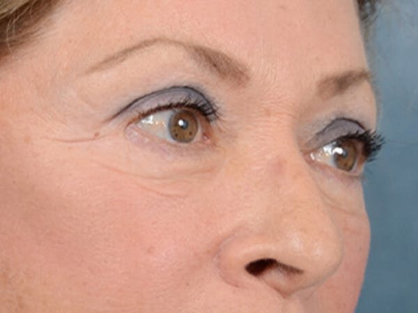 Eyelid Lift Before & After Gallery - Patient 15930444 - Image 8