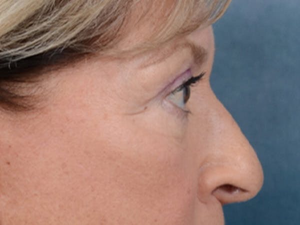 Eyelid Lift Before & After Gallery - Patient 15930444 - Image 9