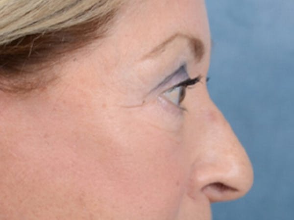 Eyelid Lift Before & After Gallery - Patient 15930444 - Image 10