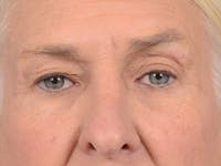 Eyelid Lift Before & After Gallery - Patient 19056130 - Image 1