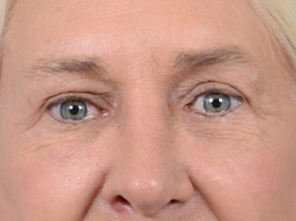 Eyelid Lift Before & After Gallery - Patient 19056130 - Image 2