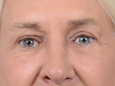 Eyelid Lift Before & After Gallery - Patient 19056130 - Image 2