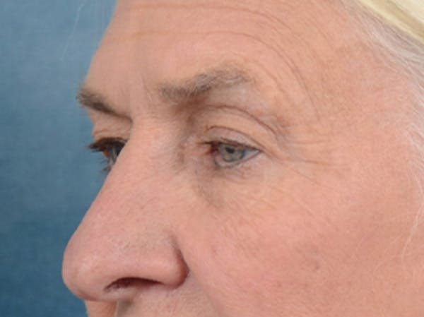 Eyelid Lift Before & After Gallery - Patient 19056130 - Image 3