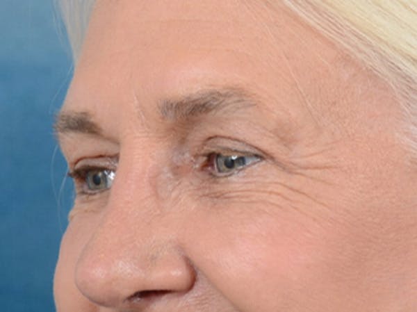 Eyelid Lift Before & After Gallery - Patient 19056130 - Image 4