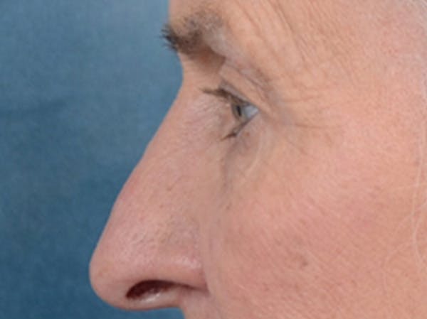 Eyelid Lift Before & After Gallery - Patient 19056130 - Image 5