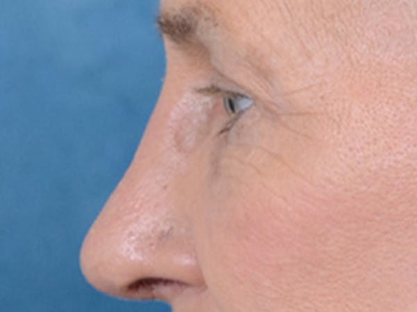 Eyelid Lift Before & After Gallery - Patient 19056130 - Image 6
