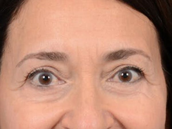 Eyelid Lift Before & After Gallery - Patient 5923298 - Image 2
